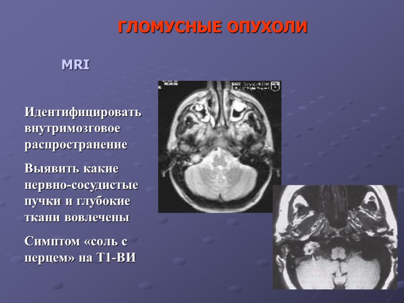 MRI Идентифицировать внутримозговое распространение Выявить какие нервно-сосудистые пучки и глубокие ткани вовлечены Симптом «соль